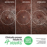 *PREORDEN:Hydrocolloid Invisible Pimple Patches - The inkey list / Parches para granitos