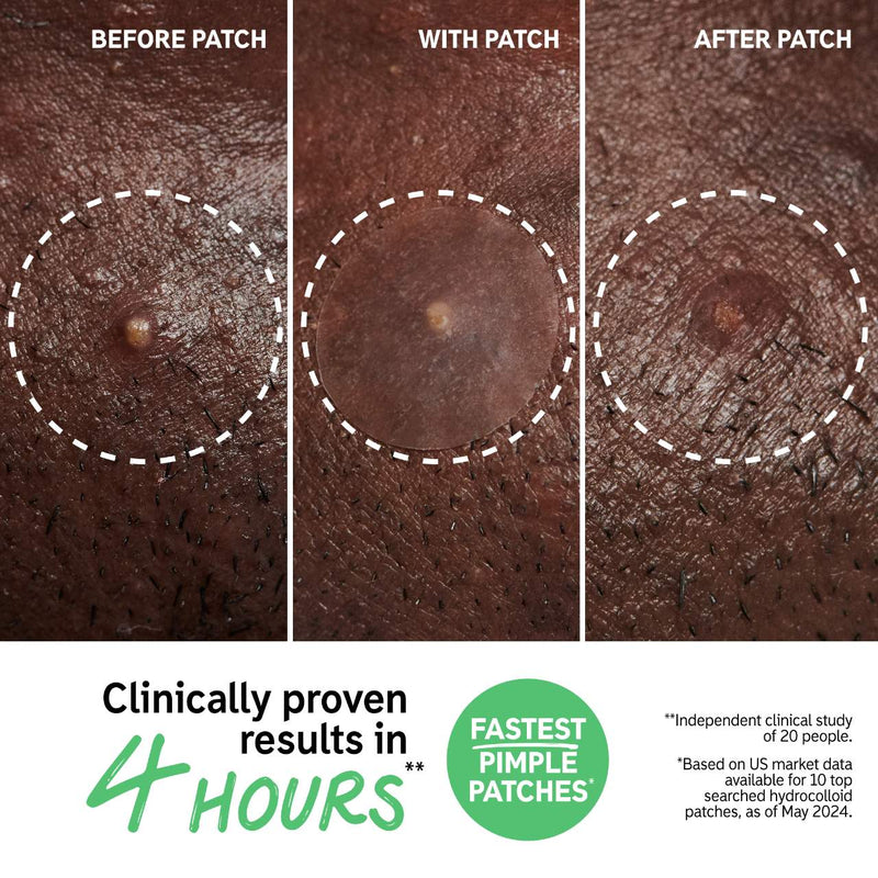 *PREORDEN:Hydrocolloid Invisible Pimple Patches - The inkey list / Parches para granitos