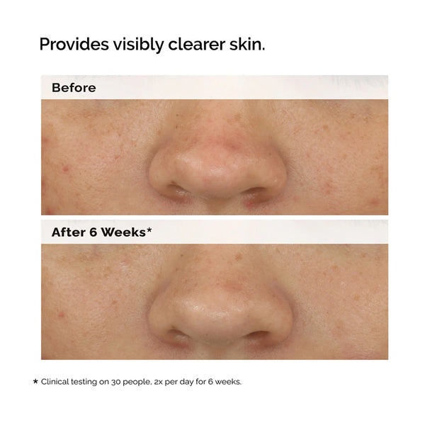 *PREORDEN: Balancing & Clarifying Serum for Blemish-Prone Skin  - The Ordinary / Suero para poros y brillo
